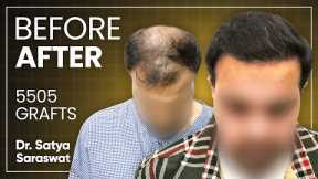 Hair Transplant Results, Cost, Month by Month Time Lapse, Best Hair Transplant in Agra, India