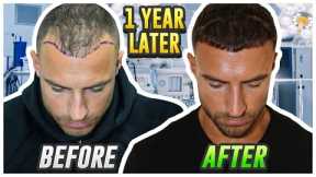 My Hair Transplant Results After 1 Year