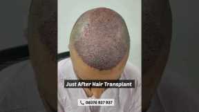 How does the hair look within 10 days of Hair Transplant|☎️08376927927 #prp #hairloss #baldness