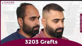 Natural Hairline & Density: 1-Year Hair Transplant Results