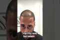 GOING BALD AFTER HAIR TRANSPLANT