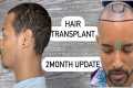 Hair Transplant 2 month Update