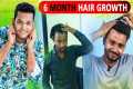 Hair Transplant 6 Month Results! Hair 