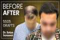 Hair Transplant Results, Cost, Month