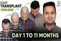 Hair Transplant Day 1 to 11 Months