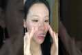 Closed Comedones Treatment