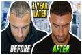 My Hair Transplant Results After 1