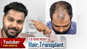Youtuber Rahul Pal Hair Transplant Journey | Fantastic Hair Transplant Results #hairtransplant