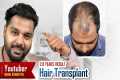 Youtuber Rahul Pal Hair Transplant