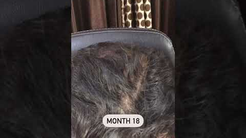[Hair Transplant] Regrow Hair without a Hair Transplant? Traya Health