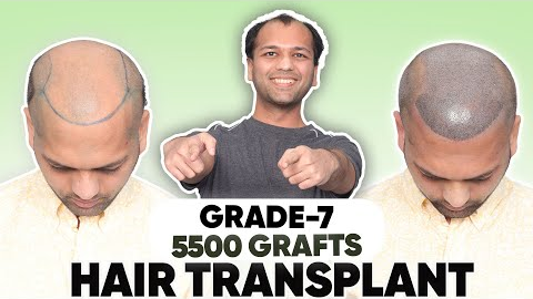 Hair Transplant in Mysore  | Best Results & Cost of Hair Transplant in Mysore