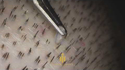 FUE Hair Transplantation Surgery (Maximum Zoom) #hairtransplant #fuemethod #hairofistanbul