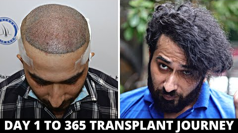 FUE Hair Transplant Timeline I Day 1 to Day 365 I Before & After | Born Creator