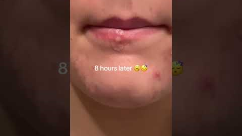 How I got rid of my pimple over night 👀 #acne #acneproneskin #skincareroutine