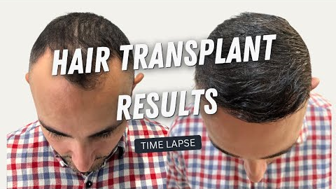 Hair Transplant Before and After | Hair Transplant Result 10 months | Hair Transplant Time lapse