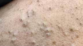 Facial Care Routine — Deep Cleansing Techniques For Acne