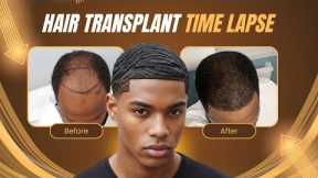 Hair Transplant Before and After: 12 Month Time Lapse Journey | Black Men Hair Loss Transformation