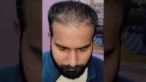 Amazing Hair Transplant Results | Latest Fue Technique #shorts #viral #hair transplant