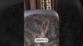 [Hair Transplant] Regrow Hair without a Hair Transplant? Traya Health