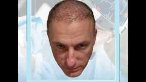 The Hair Dr - Hair Transplant Journey