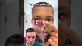 Black Hair Transplants: Why Your Hairline Matters