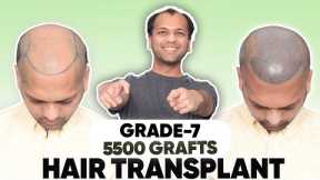 Hair Transplant in Mysore  | Best Results & Cost of Hair Transplant in Mysore