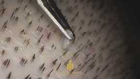 FUE Hair Transplantation Surgery (Maximum Zoom) #hairtransplant #fuemethod #hairofistanbul