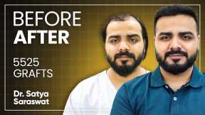 Hair Transplant in Results, Cost, Before and After Time Lapse | Best Hair Transplant India