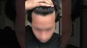 Transforming Hair, Transforming Lives! Witness the amazing results of our hair transplant procedure