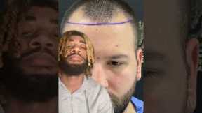 AMAZING Hair Transplant Growth #shorts