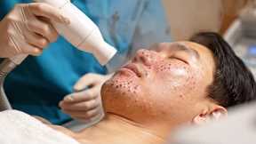 Skincare | Extreme Blackheads Removal #tweezers skincare #blackheads blackheads