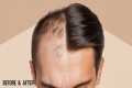 Hair Transplant  Before and After |