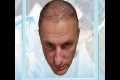The Hair Dr - Hair Transplant Journey