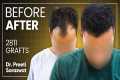 Hair Transplant Results, Cost, Before 
