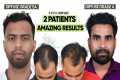 Hair Transplant in Indore | Best