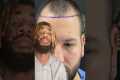AMAZING Hair Transplant Growth #shorts