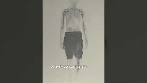 Nerve Damage in Diabetes: Diabetic Peripheral Neuropathy Explained #diabetes #neuropathy