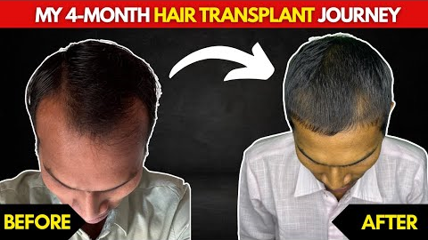 Hair Transplant 4 Months Update 🧑‍🦲➡️🧑‍🦱 | Real Results, Shedding Phase & Regrowth!