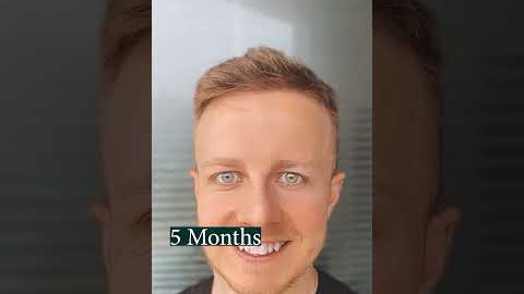 1 Year Hair Growth After Hair Transplant (Time-Lapse)