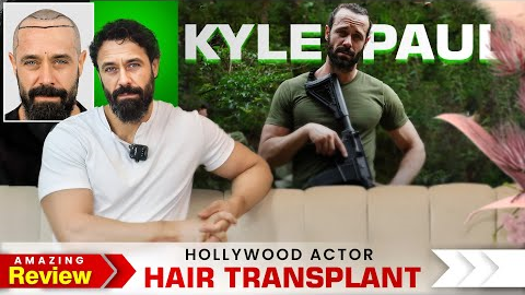 Hollywood Actor @kyle_paul Hair Transplant Journey | Amazing Hair Transplant Results in India