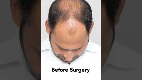 17 Months Hair Transplant Results | Latest Fue Technique #shorts #viral #hair transplant