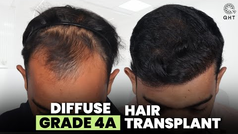 Hair Transplant in Surat (HX-AQWT) | Best Results & Cost of Hair Transplant in Surat