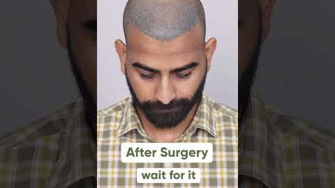Ten Months Hair Transplant Results | Latest Fue Technique #shorts #viral #hair transplant