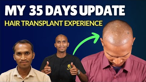 My 35 Days Hair Transplant Update! (Progress & Results) 🏥
