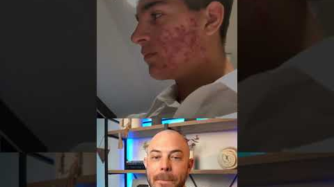 Derm reacts to unbelievable acne transformation! #dermreacts #doctorreacts #accutane