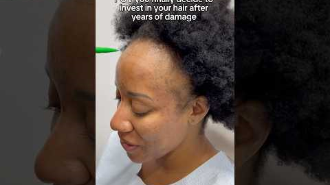 POV You Finally Decide to Invest in Your Hair! #hairgrowth #hairlosssolution