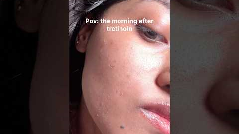 How I repair my dry irritated skin after tretinoin/retinol ✨ #acne #skincaretips #glassskin