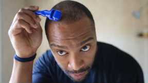 2–3 Month Hair Transplant Update: Numbness, Derma Rolling & Early Growth