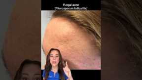 Use THIS Not THAT: Fungal Acne — From A Derm | #shorts #skincare |