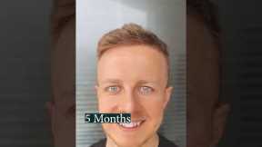 1 Year Hair Growth After Hair Transplant (Time-Lapse)